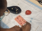 We also had dermatologists try out our shave biopsy tool and give us feedback