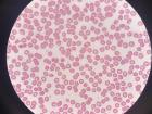 Here's what malaria looks like under the scope: red circles are red blood cells, the purple dots next to the red cells are platelets and the faint purple rings inside some of the red cells are the parasite!